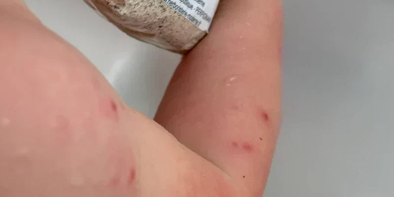 Varicelle : un bain d’Avoine et un spray de Camomille pour le confort de la peau