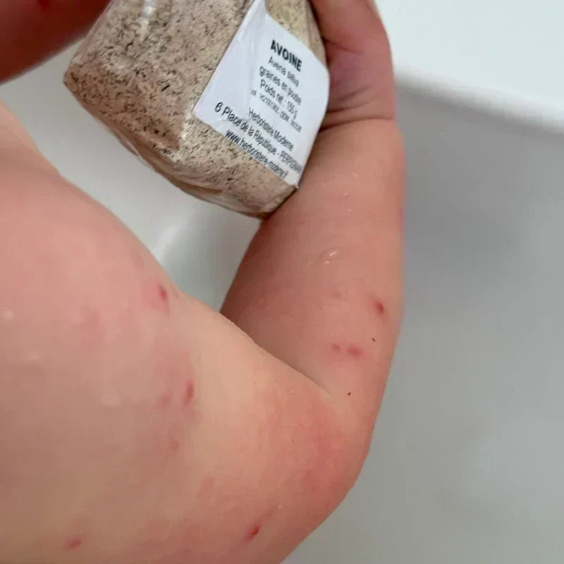 Varicelle : un bain d’Avoine et un spray de Camomille pour le confort de la peau